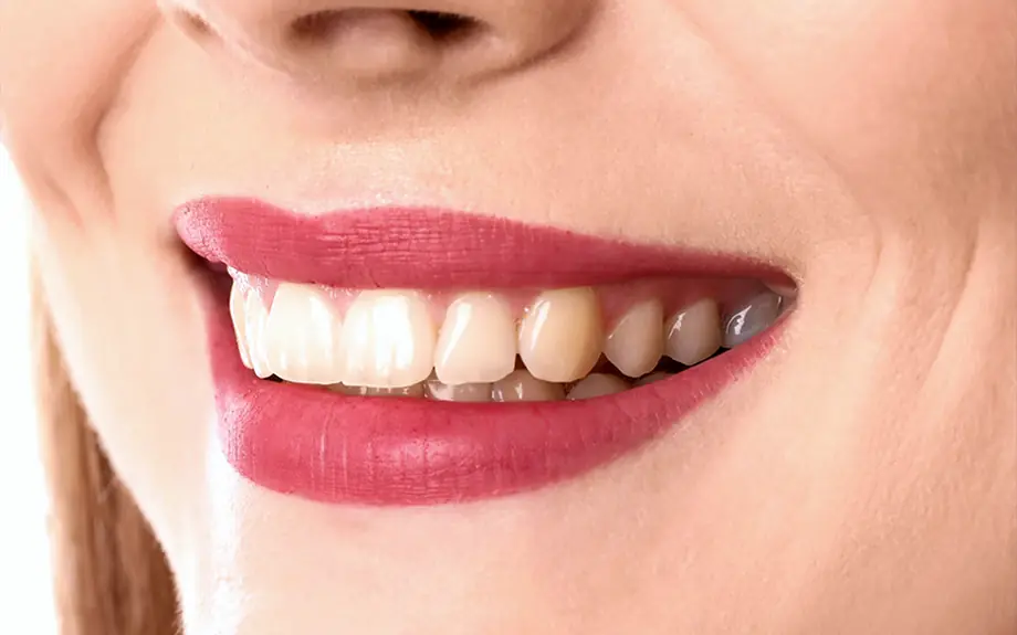 Dental Implants at Brighter Smile, North Vancouver